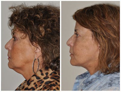Facelift Before & After Gallery - Patient 30624100 - Image 2