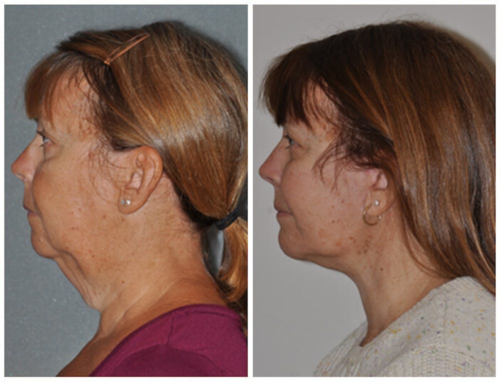 Facelift Before & After Gallery - Patient 30624102 - Image 2