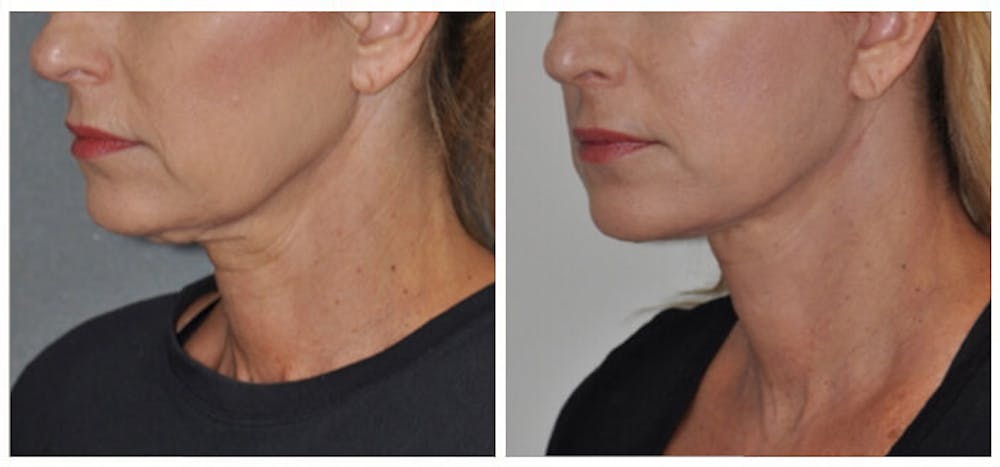Facelift Before & After Gallery - Patient 30624103 - Image 1