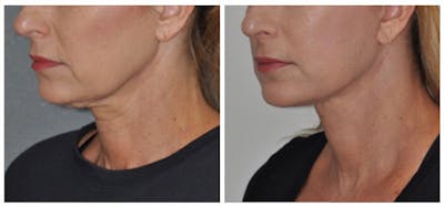 Facelift Before & After Gallery - Patient 30624103 - Image 1