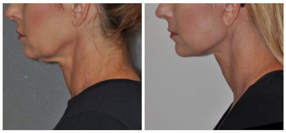Facelift Before & After Gallery - Patient 30624103 - Image 2