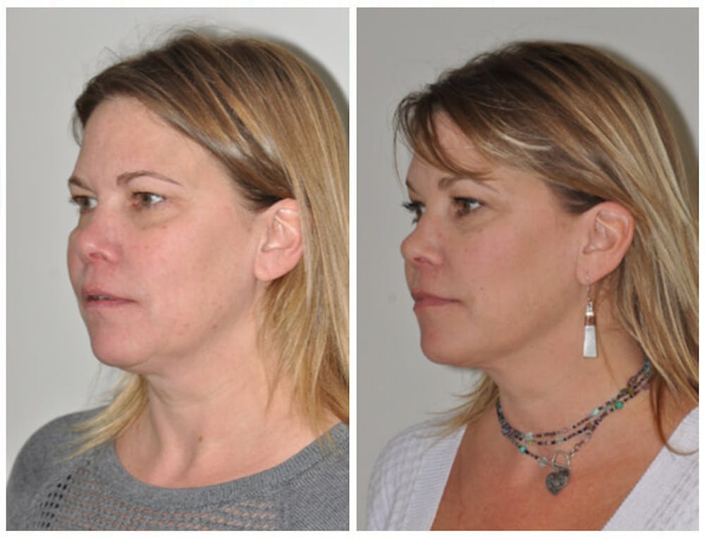 FaceTite & ThermiTight Before & After Gallery - Patient 30624109 - Image 1