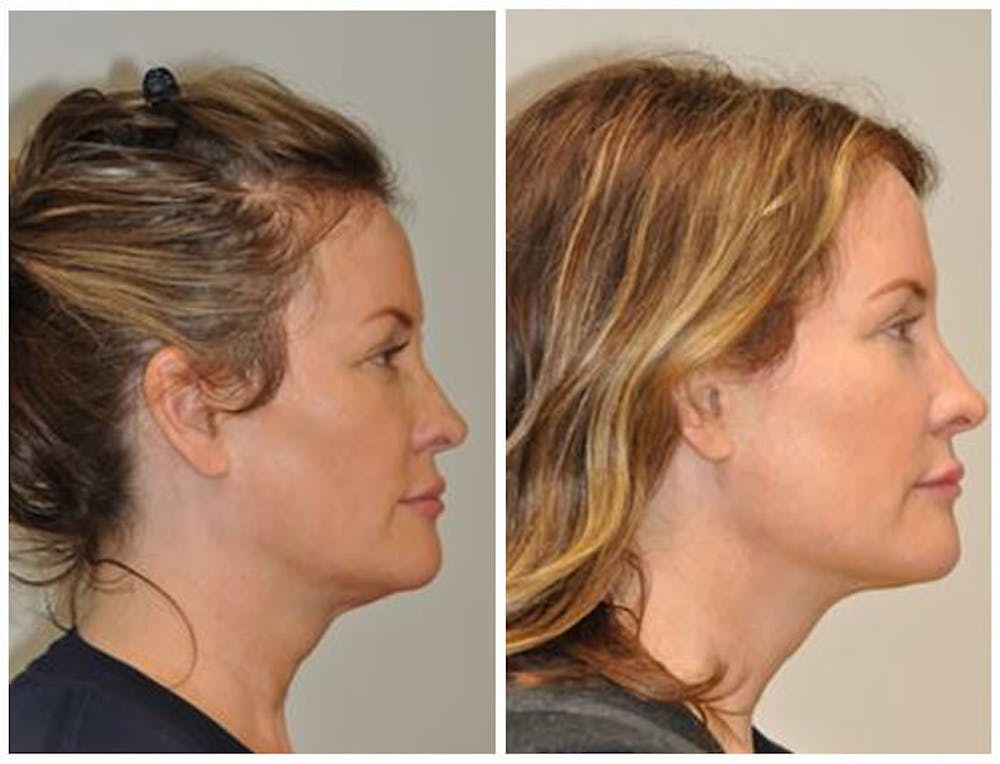FaceTite & ThermiTight Before & After Gallery - Patient 30624110 - Image 1