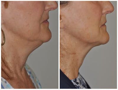 FaceTite & ThermiTight Before & After Gallery - Patient 30624111 - Image 1