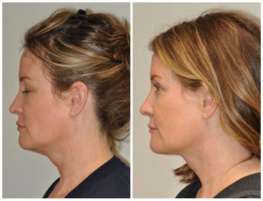 FaceTite & ThermiTight Before & After Gallery - Patient 30624110 - Image 2