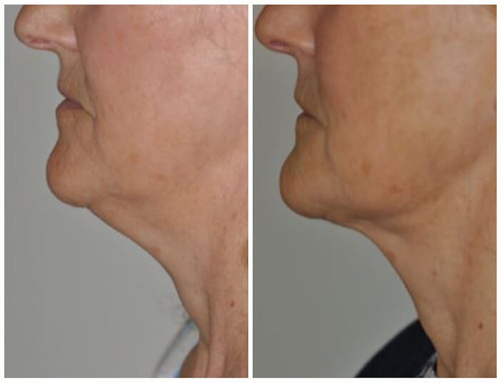 FaceTite & ThermiTight Before & After Gallery - Patient 30624111 - Image 2