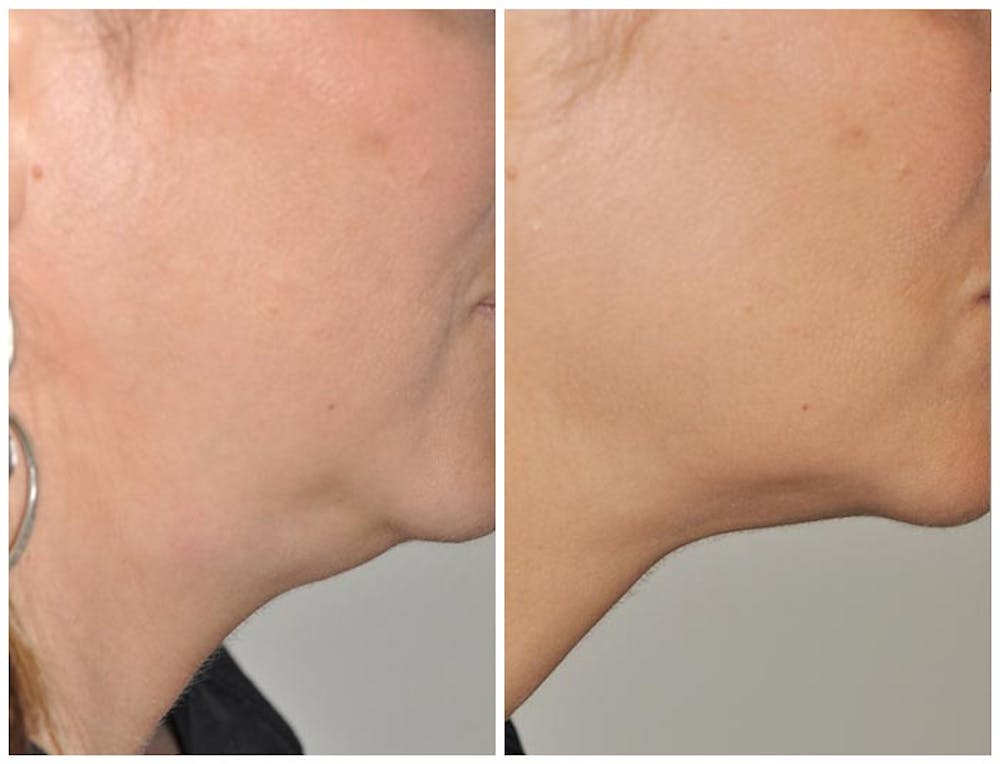 Kybella Before & After Gallery - Patient 30624127 - Image 2