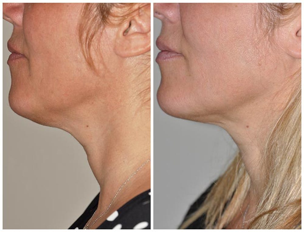 Kybella Before & After Gallery - Patient 30624129 - Image 1
