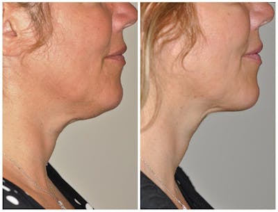 Kybella Before & After Gallery - Patient 30624129 - Image 2