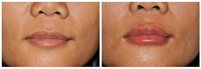 Lip Augmentation Before & After Gallery - Patient 30624142 - Image 1