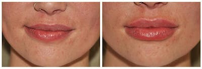 Lip Augmentation Before & After Gallery - Patient 30624143 - Image 1