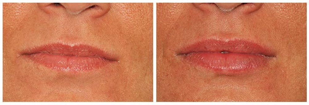 Lip Augmentation Before & After Gallery - Patient 30624144 - Image 1