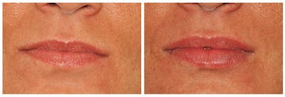 Lip Augmentation Before & After Gallery - Patient 30624144 - Image 1