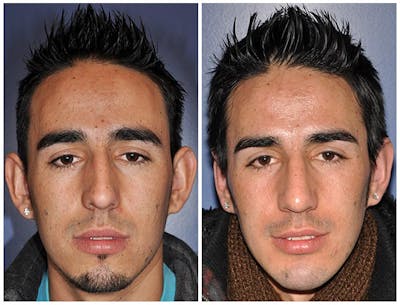 Otoplasty Before & After Gallery - Patient 30624156 - Image 1
