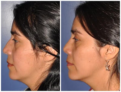 Rhinoplasty Before & After Gallery - Patient 30624167 - Image 1