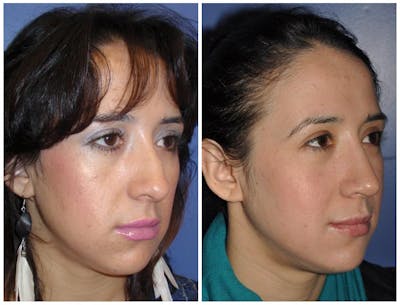 Rhinoplasty Before & After Gallery - Patient 30624168 - Image 1