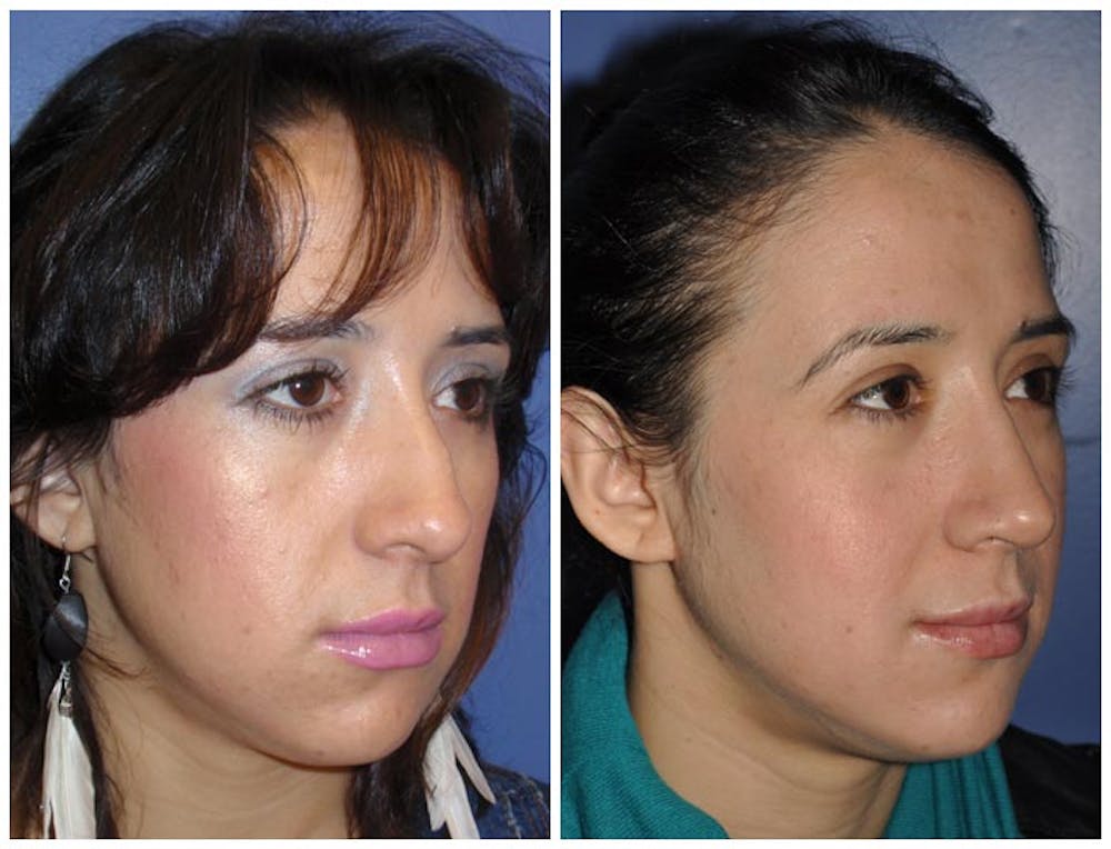 Rhinoplasty Before & After Gallery - Patient 30624168 - Image 1
