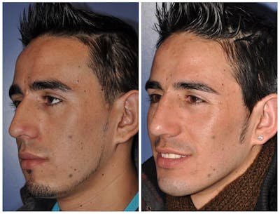Rhinoplasty Before & After Gallery - Patient 30624169 - Image 1