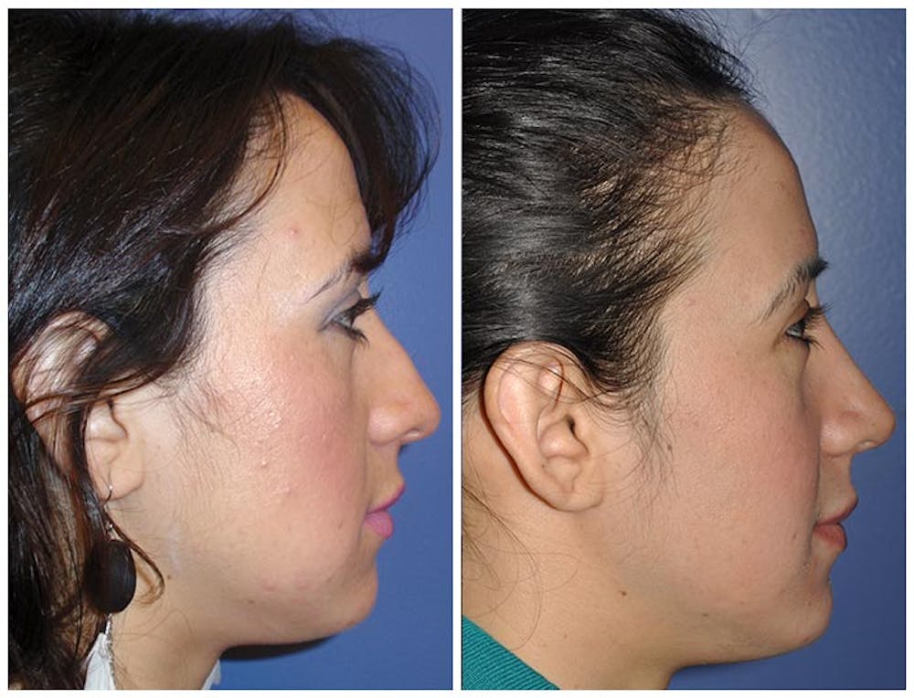 Rhinoplasty Before & After Gallery - Patient 30624168 - Image 2