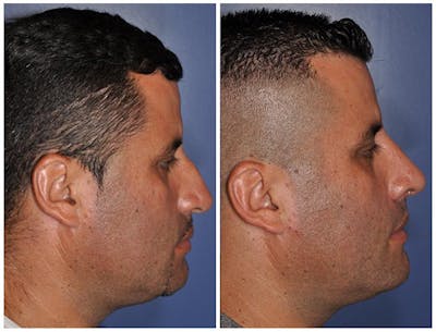 Rhinoplasty Before & After Gallery - Patient 30624170 - Image 1