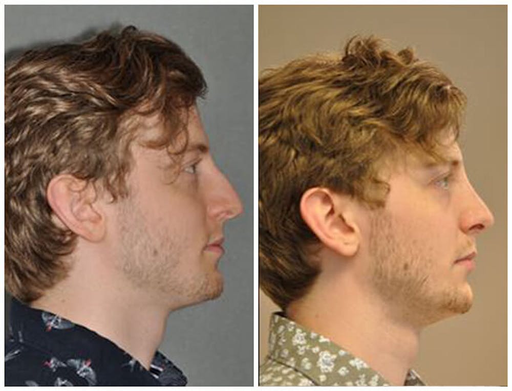 Rhinoplasty Before & After Gallery - Patient 30624172 - Image 1