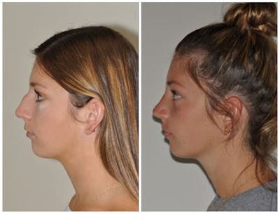 Rhinoplasty Before & After Gallery - Patient 30624173 - Image 1