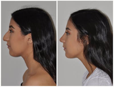 Rhinoplasty Before & After Gallery - Patient 30624175 - Image 1