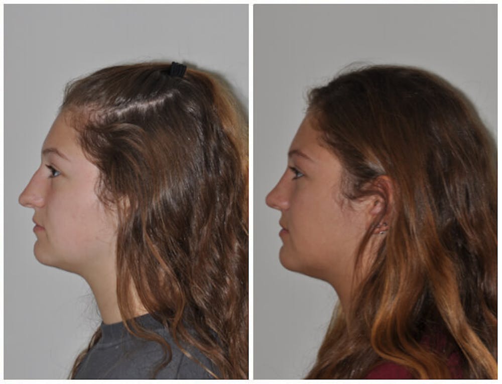 Rhinoplasty Before & After Gallery - Patient 30624174 - Image 3