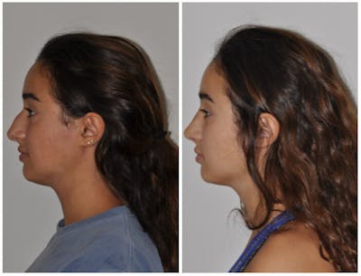 Rhinoplasty Before & After Gallery - Patient 30624177 - Image 1