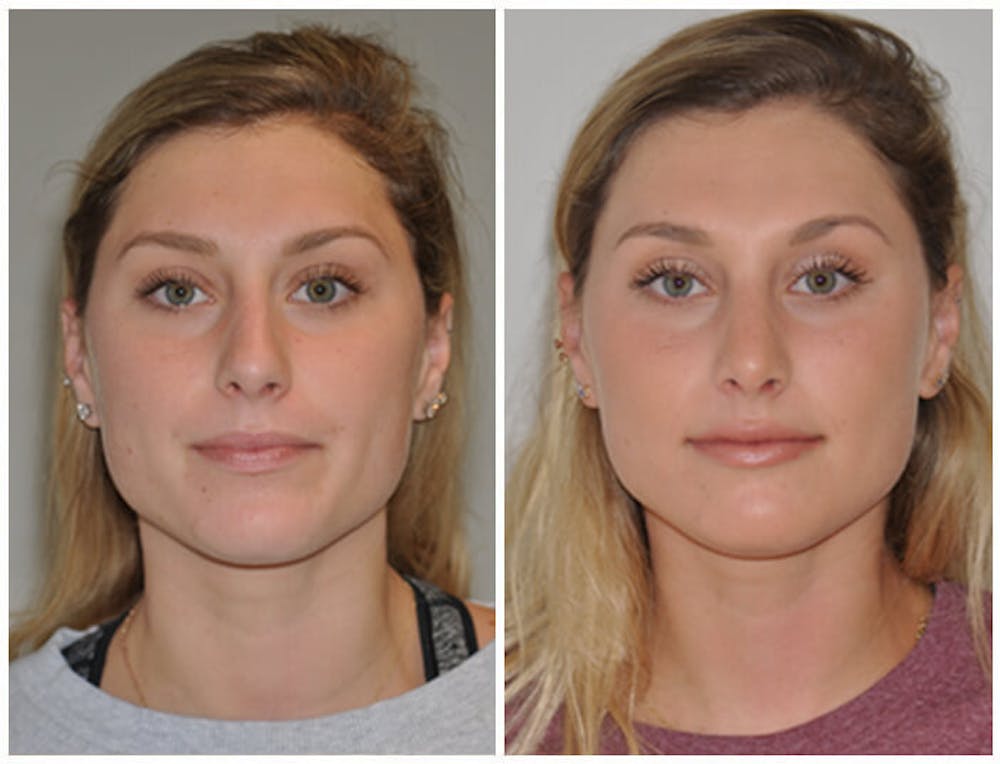 Rhinoplasty Before & After Gallery - Patient 30624176 - Image 3