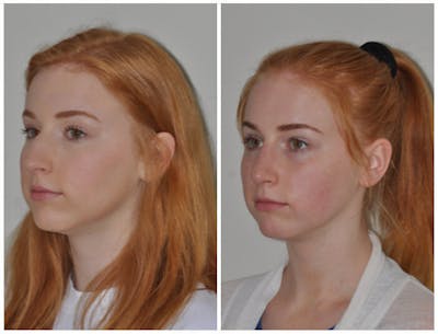 Rhinoplasty Before & After Gallery - Patient 30624178 - Image 1