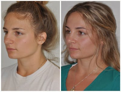 Rhinoplasty Before & After Gallery - Patient 30624180 - Image 1
