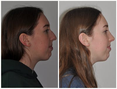 Rhinoplasty Before & After Gallery - Patient 30624181 - Image 1