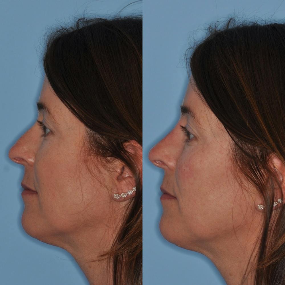 Non-Surgical Rhinoplasty Before & After Gallery - Patient 31709163 - Image 1