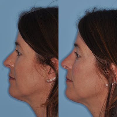 Non-Surgical Rhinoplasty Before & After Gallery - Patient 31709163 - Image 1