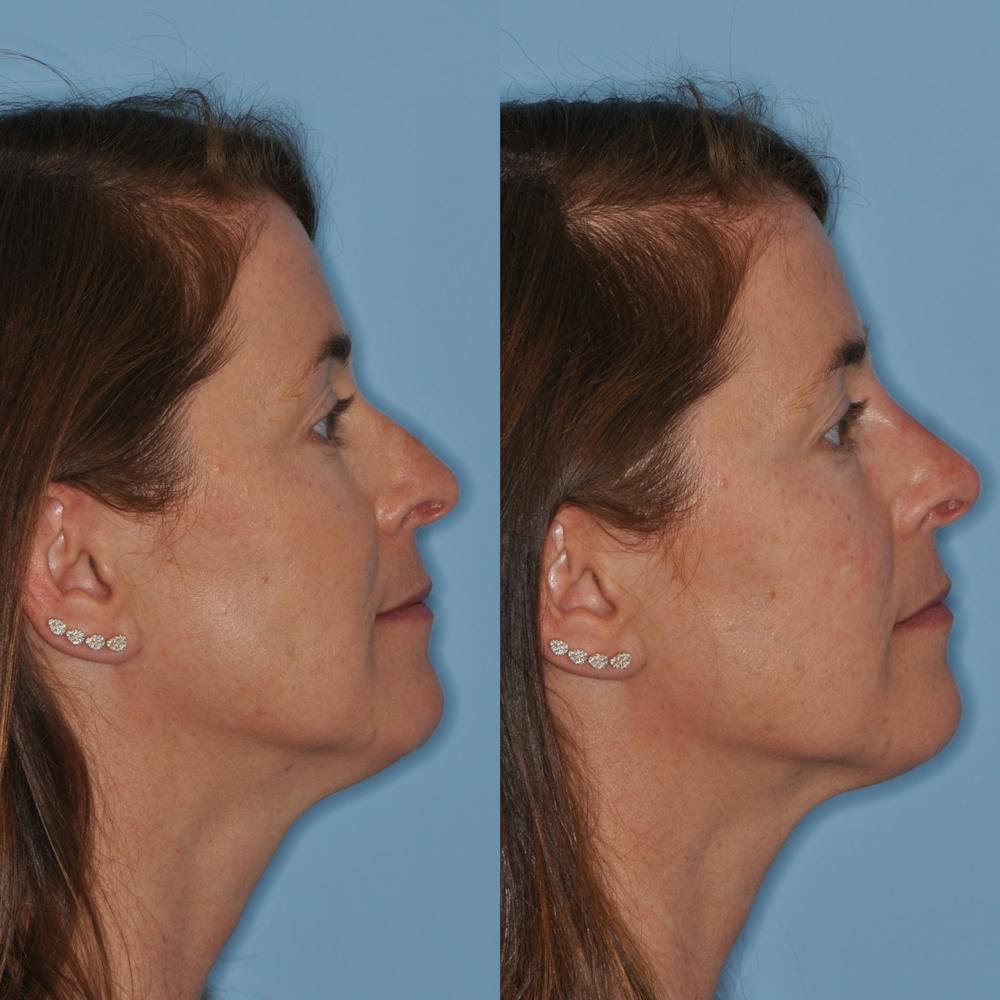 Non-Surgical Rhinoplasty Before & After Gallery - Patient 31709163 - Image 2