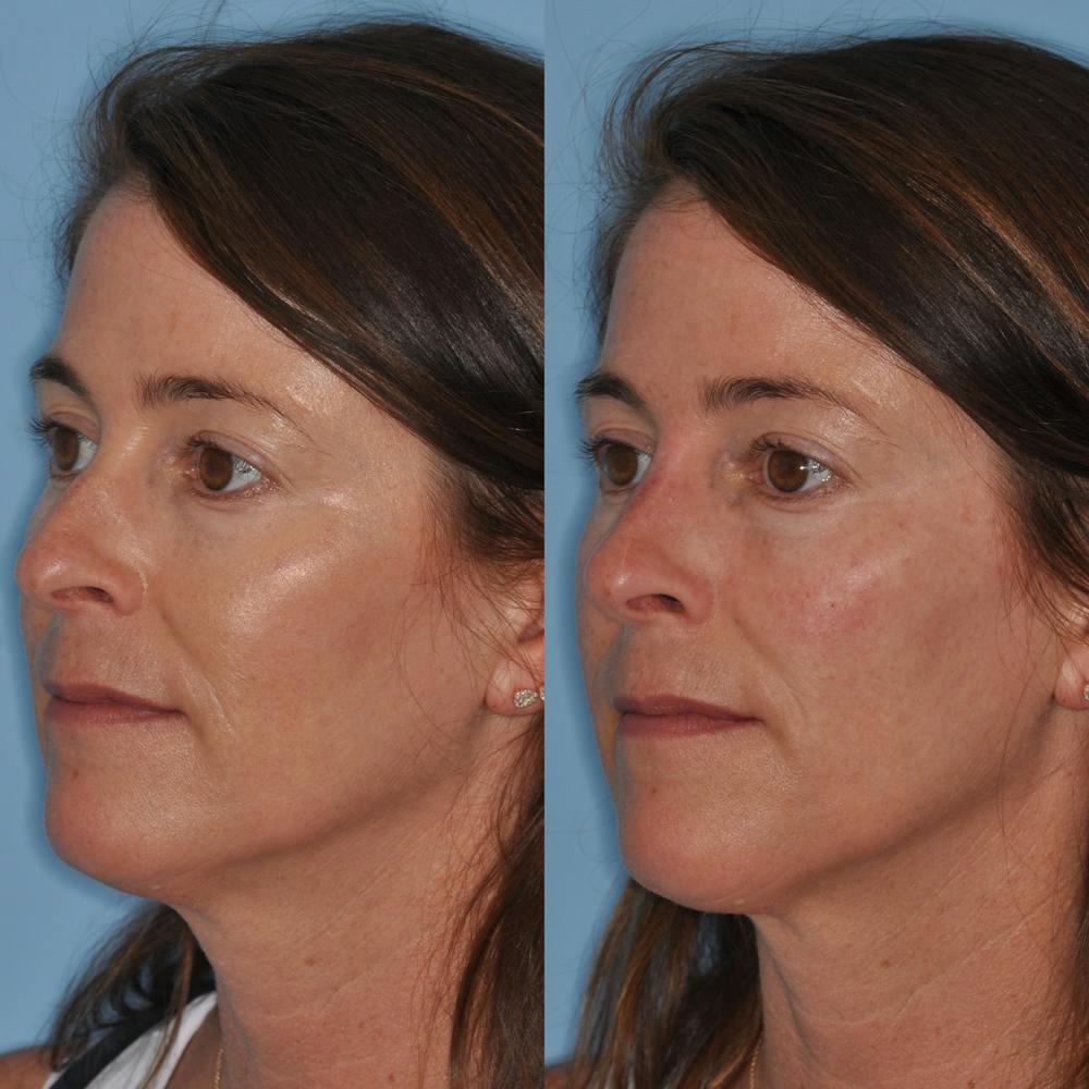 Non-Surgical Rhinoplasty Before & After Gallery - Patient 31709163 - Image 4