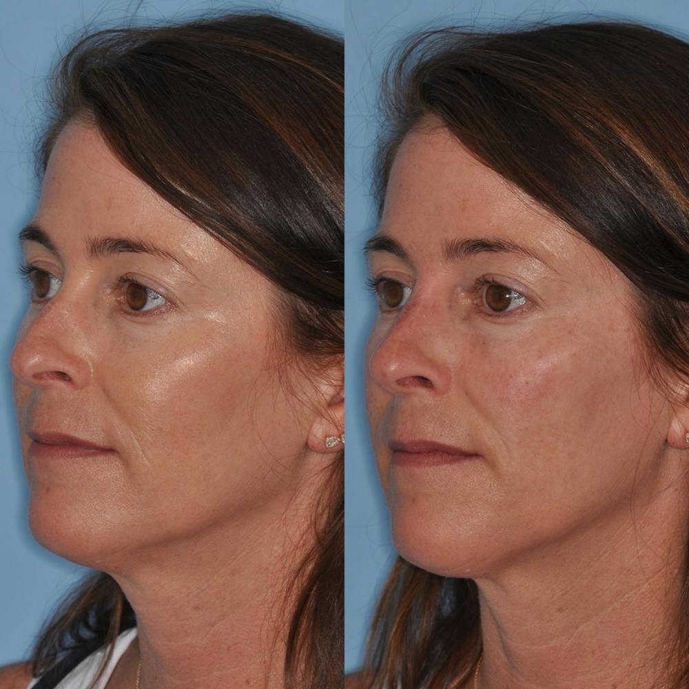 Non-Surgical Rhinoplasty Before & After Gallery - Patient 31709163 - Image 5