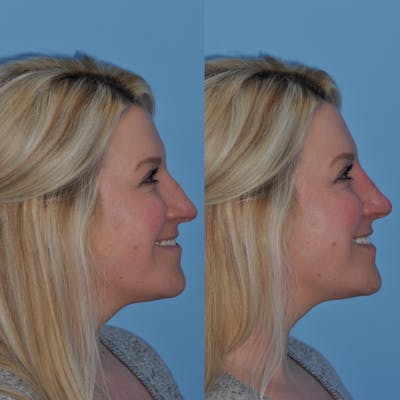 Non-Surgical Rhinoplasty Before & After Gallery - Patient 31709165 - Image 1