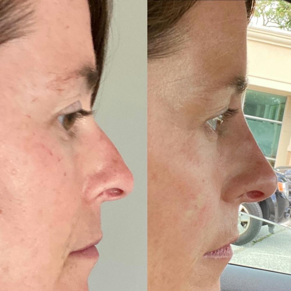 Non-Surgical Rhinoplasty Before & After Gallery - Patient 31709163 - Image 7