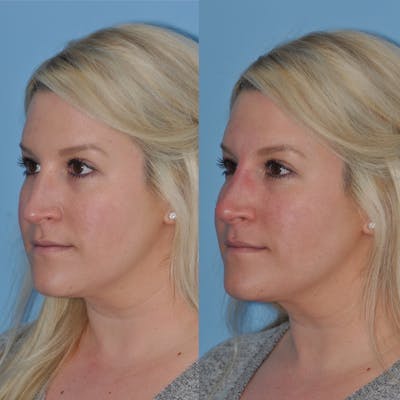 Non-Surgical Rhinoplasty Before & After Gallery - Patient 31709165 - Image 2