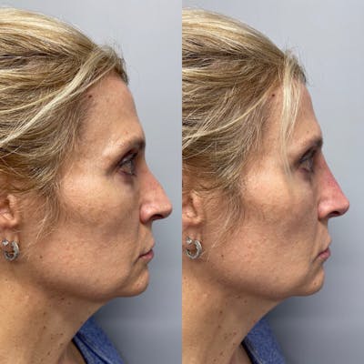 Non-Surgical Rhinoplasty Before & After Gallery - Patient 31709166 - Image 1
