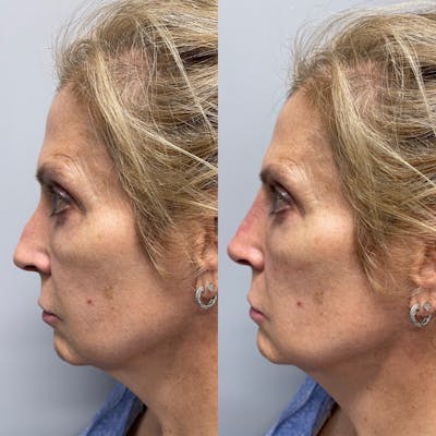 Non-Surgical Rhinoplasty Gallery - Patient 31709166 - Image 2