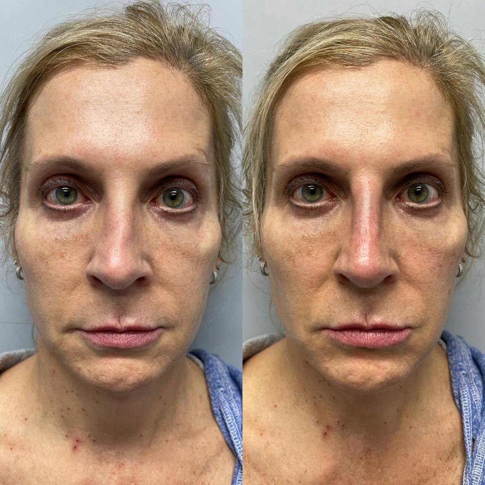 Non-Surgical Rhinoplasty Before & After Gallery - Patient 31709166 - Image 3
