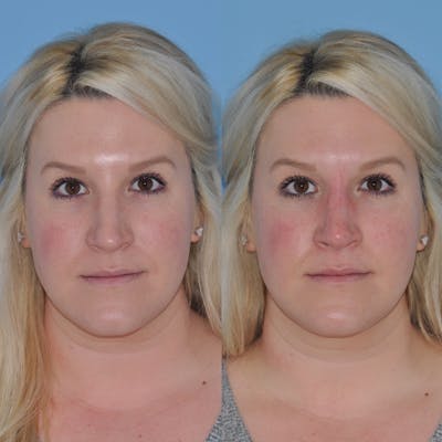 Non-Surgical Rhinoplasty Before & After Gallery - Patient 31709165 - Image 6