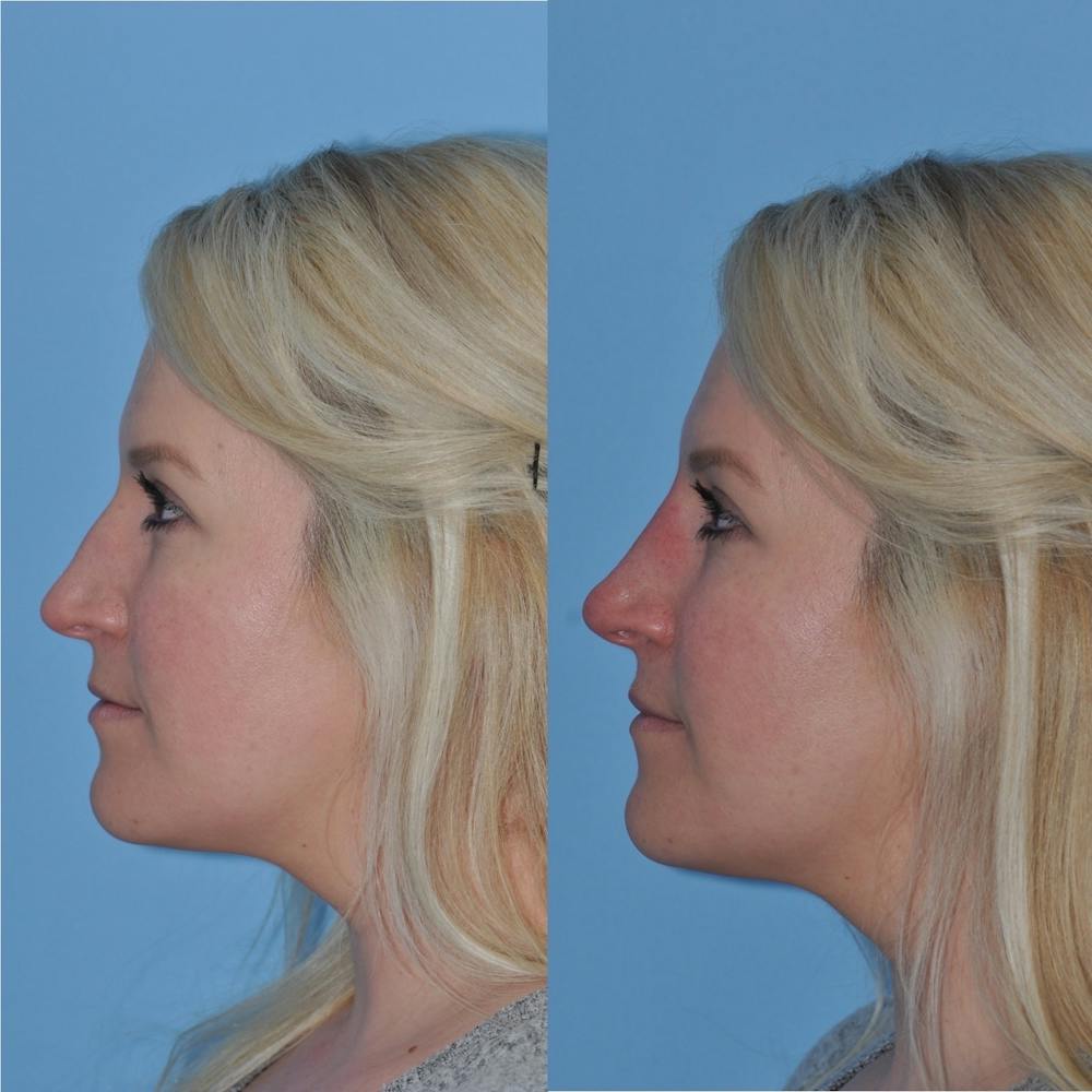 Non-Surgical Rhinoplasty Before & After Gallery - Patient 31709165 - Image 7