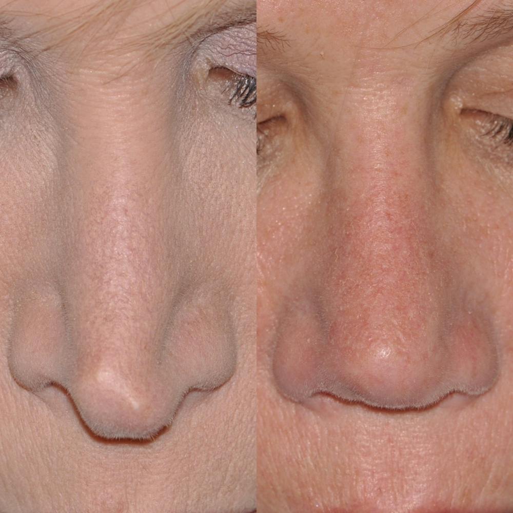 Revision Rhinoplasty Gallery - Patient 30624186 - Image 4