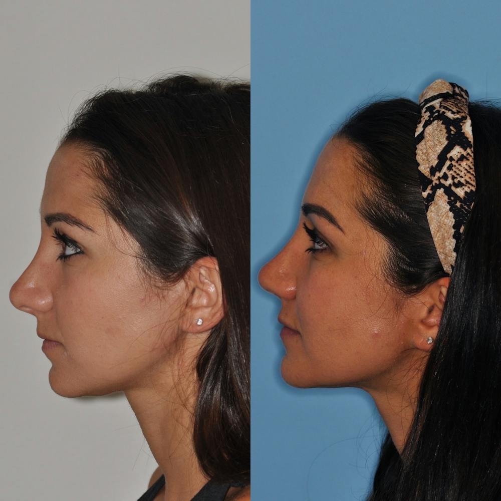 Revision Rhinoplasty Before & After Gallery - Patient 31709170 - Image 1