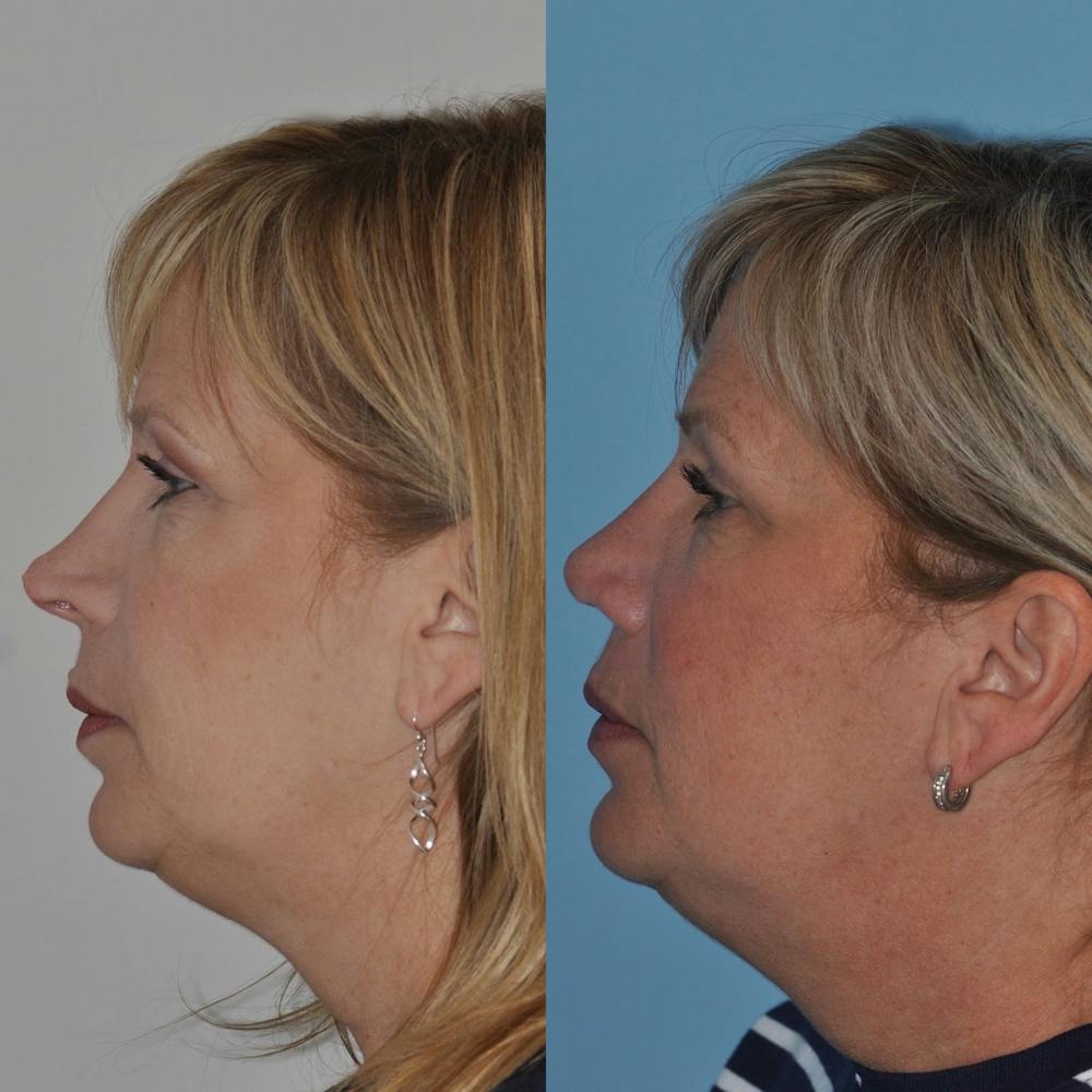 Revision Rhinoplasty Before & After Gallery - Patient 30624186 - Image 1