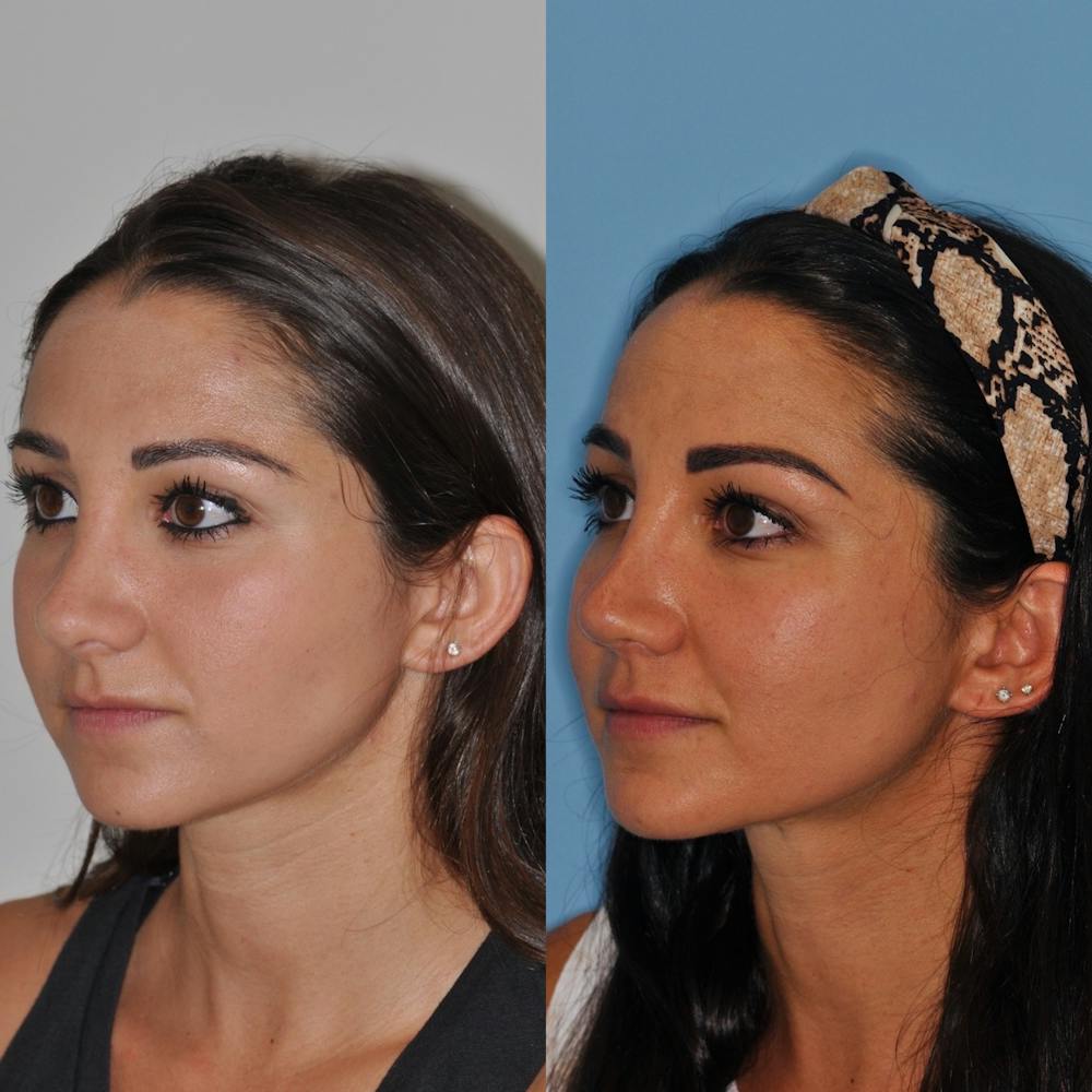 Revision Rhinoplasty Before & After Gallery - Patient 31709170 - Image 2